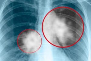 ANTOFAGASTA: MUERTES POR CANCER AL PULMÓN SON 4 A 5 VECES MÁS ALTA QUE EN EL SUR DEL PAÍS