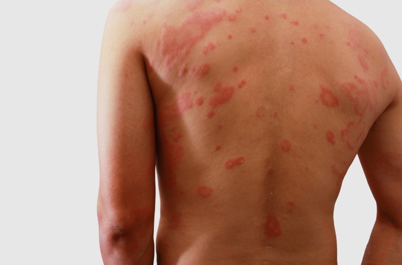 VIVIR CON DERMATITIS ATÓPICA: LA LUCHA DIARIA CONTRA LA PICAZÓN Y EL DOLOR