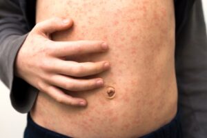 EXPERTO DE LA UA ADVIERTE SOBRE RIESGOS DEL SARAMPIÓN ANTE DETECCIÓN DE CASOS IMPORTADOS