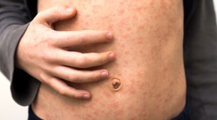 EXPERTO DE LA UA ADVIERTE SOBRE RIESGOS DEL SARAMPIÓN ANTE DETECCIÓN DE CASOS IMPORTADOS