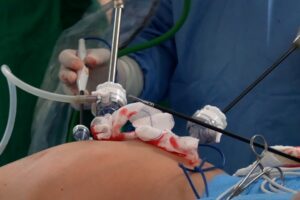 AVANCE QUIRÚRGICO EN EL HRA PERMITE REALIZAR COMPLEJA CIRUGÍA DE CÁNCER DE COLON POR VÍA LAPAROSCÓPICA