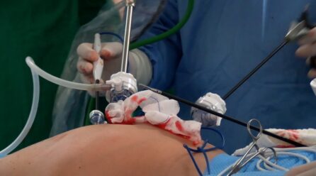 AVANCE QUIRÚRGICO EN EL HRA PERMITE REALIZAR COMPLEJA CIRUGÍA DE CÁNCER DE COLON POR VÍA LAPAROSCÓPICA